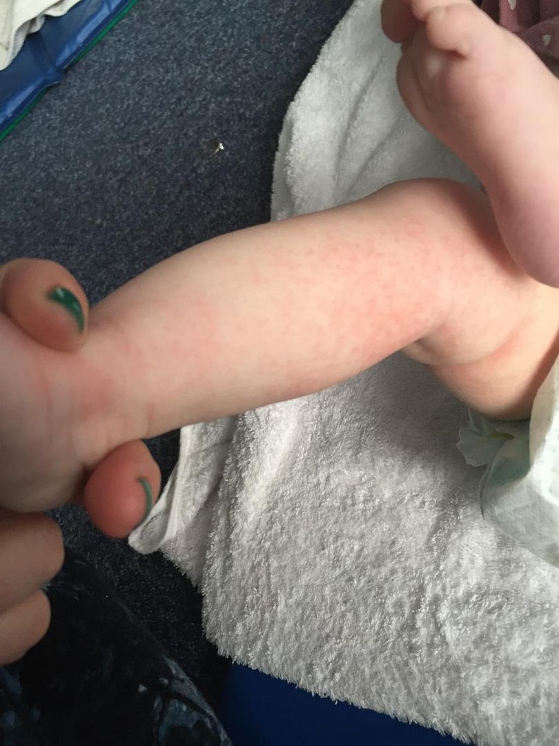 Allergy to sunflower seeds? *pic* BabyCentre